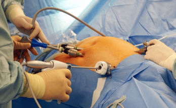 bariatric surgery devices market