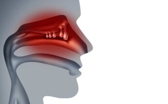 Nasal Polyps Treatment Global Market