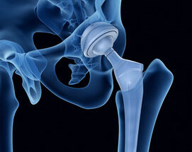 Hip Replacement Implants Market Size