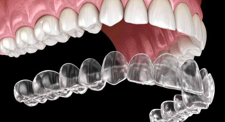 Clear Aligners