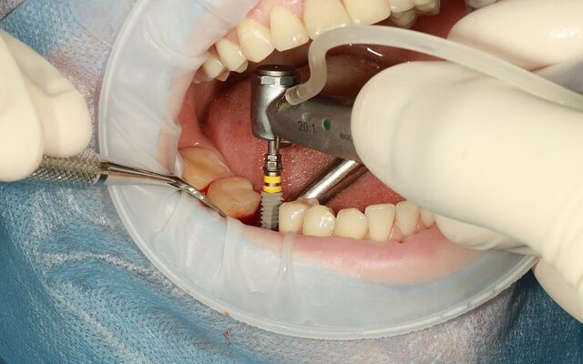 Dental Implants Market