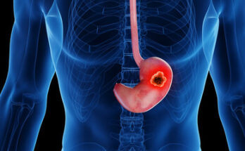 Gastric Cancer Drugs Market Size, Trends and Global Forecast To 2032