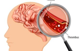 Acute Ischemic Stroke Diagnosis Market Size