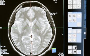 Elastography Imaging