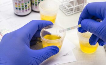 Urine Sediment Testing Market