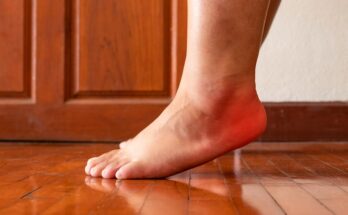 Diabetic Foot Ulcer Market