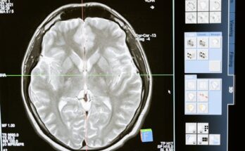 Acute Ischemic Stroke Diagnosis