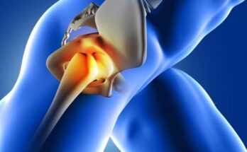 Global Hip Replacement Market Size