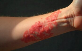 Dermatitis